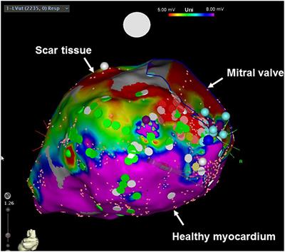 Devices in Heart Failure Patients—Who Benefits From ICD and CRT?
